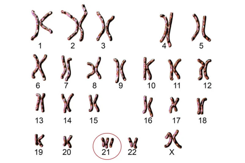 Hội chứng Down (Trisomy 21)