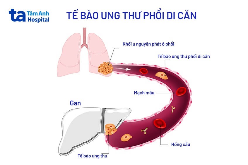 Ung thư di căn là gì? Các tế bào di căn như thế nào và dấu hiệu